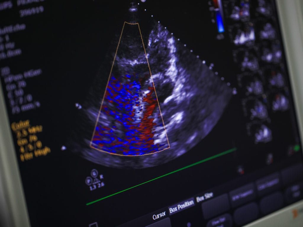 Echocardiagram readings on a monitor