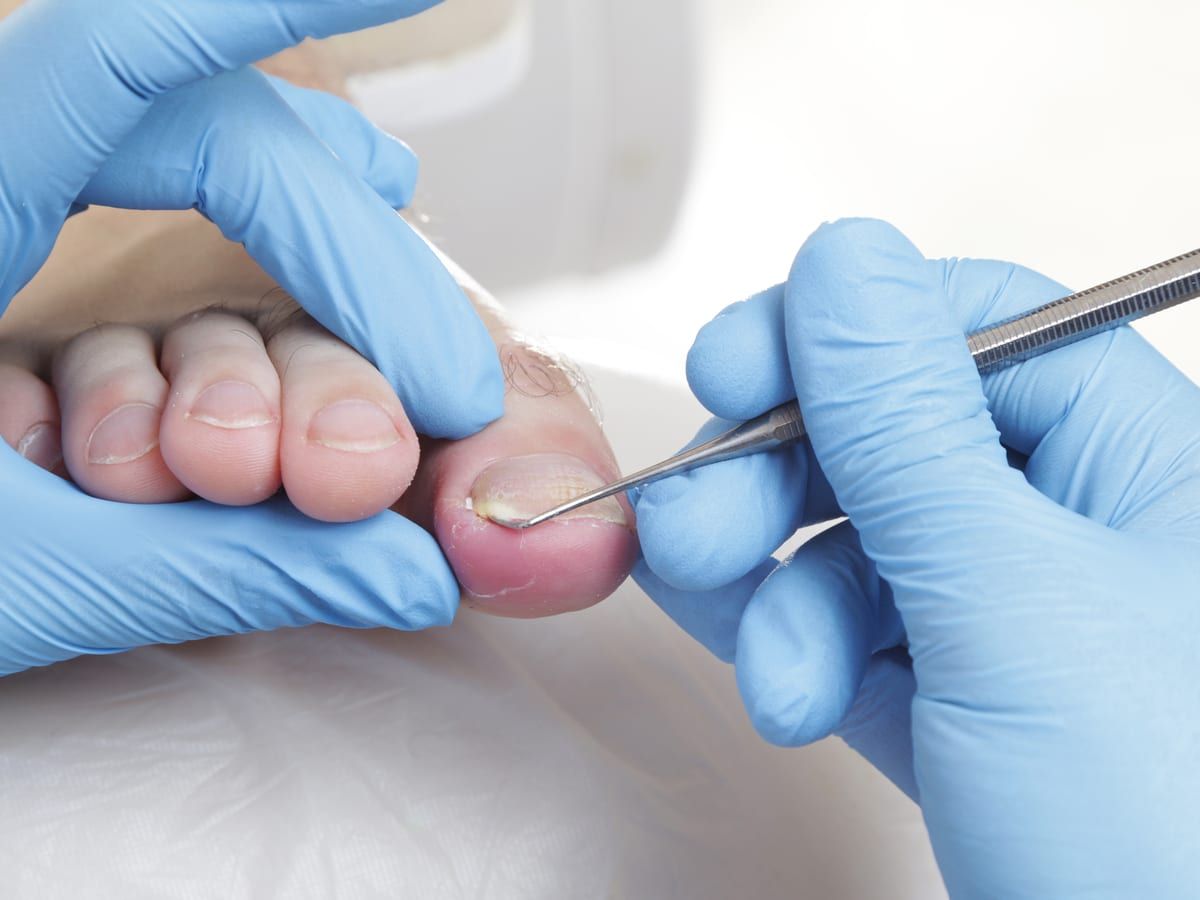 Ingrown Toenail Treatment At MD First Primary Urgent Care