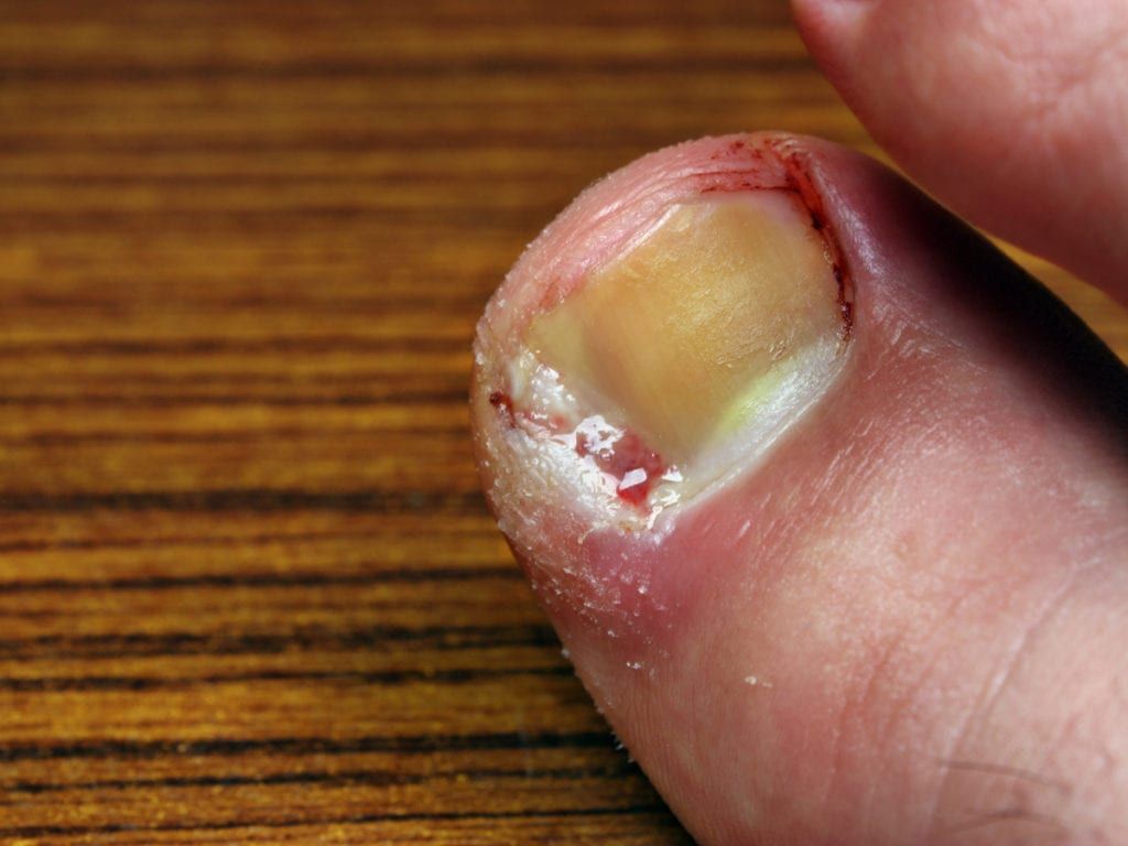 Ingrown Toenail Treatment | HK Podiatry | Maroubra & Padstow Podiatrists